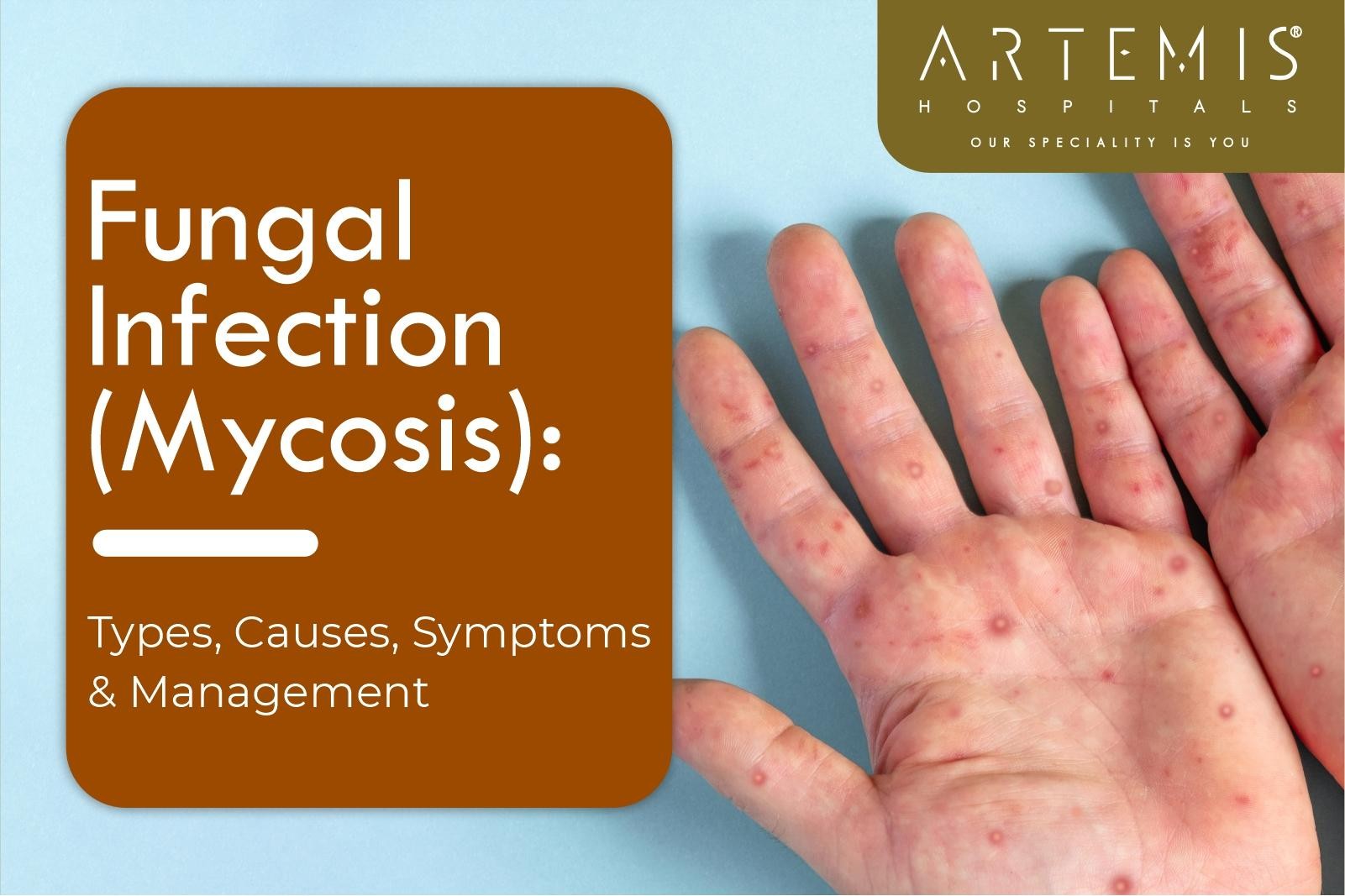 Fungal Infection (Mycosis): Types, Causes, Symptoms & Management