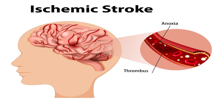 ischemic-stroke-symptoms-prevention-and-treatment-options